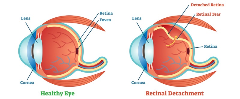 illustration-of-healthy-eye-vs-retinal-detachment-Dr. Ashish Mitra Prayagraj