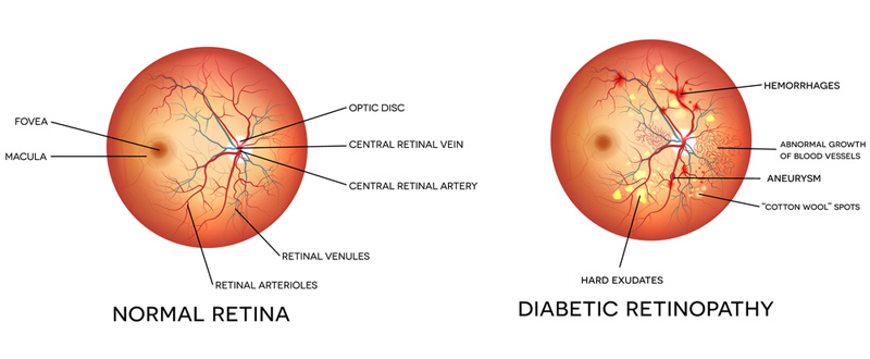 illustration-showing-diabetic-retinopathy-Dr. Ashish Mitra Prayagraj